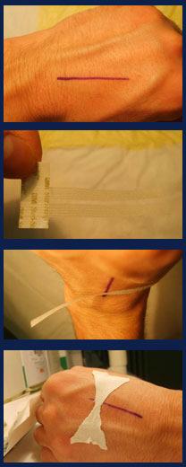 Suture Adesive Suture Adesive